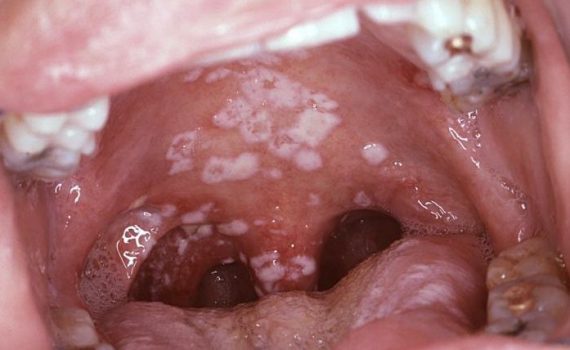 Chlamydia in the Throat - Oral Chlamydia